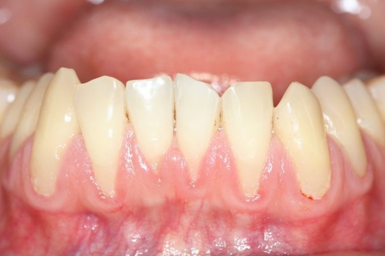 can-receded-gums-grow-back-valley-dentists-of-belchertown-blog